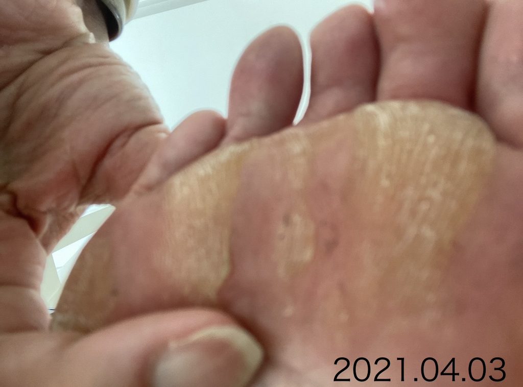 2021年4月、広い範囲に硬い角質が見られたお客様の足裏