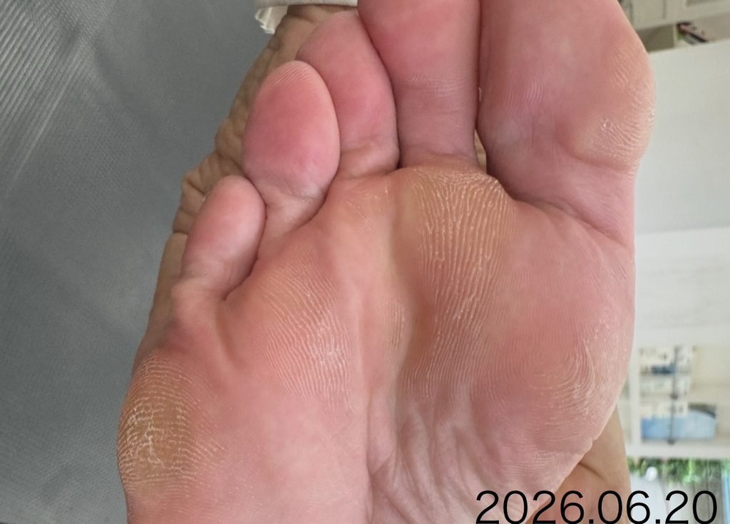 2026年6月、5年間足元を見直してきたお客様の足裏